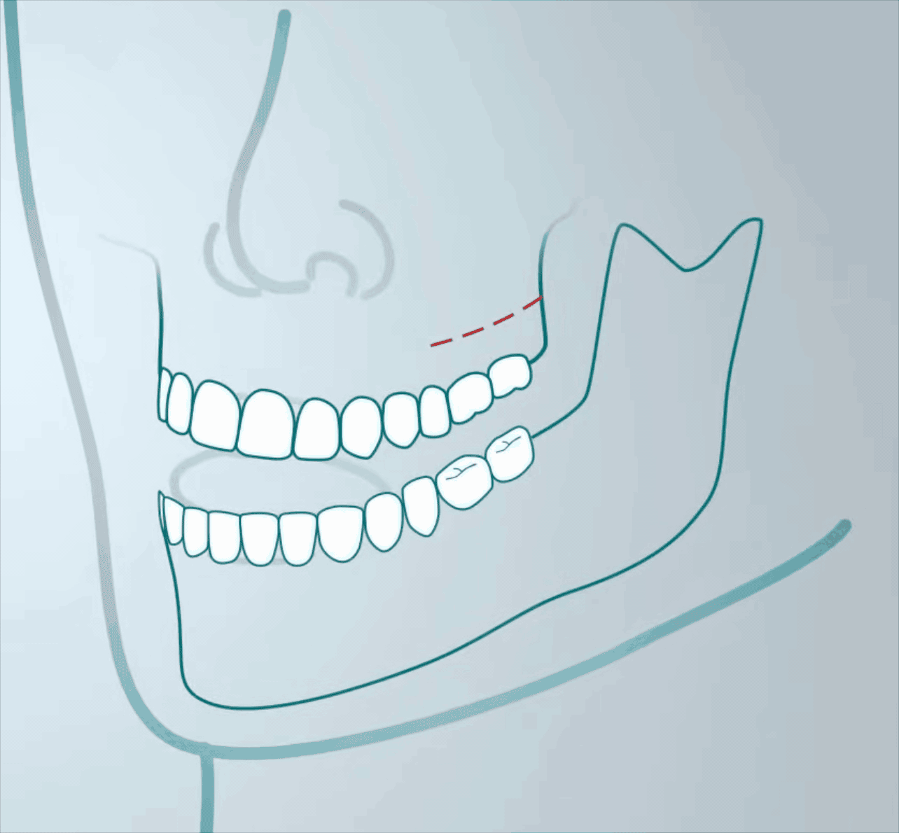 Orthodontie Adulte à La Fare-les-Oliviers, proche de Aix et Lançon