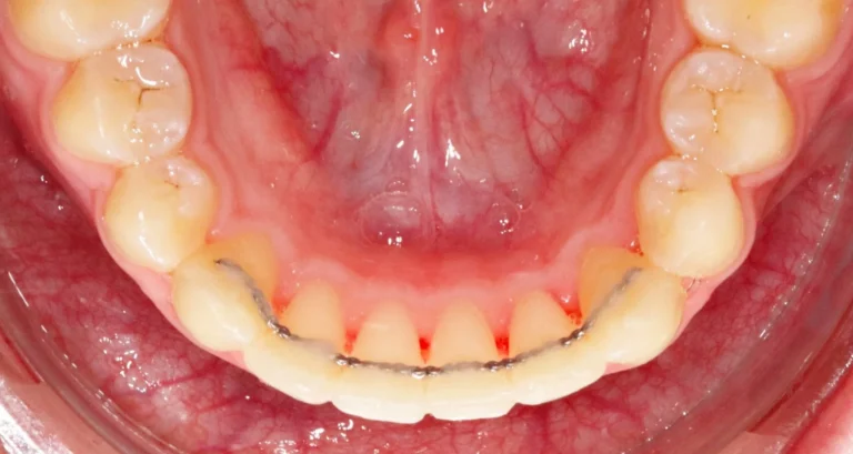 Contention Orthodontique à La Fare-les-Oliviers, près de Lançon