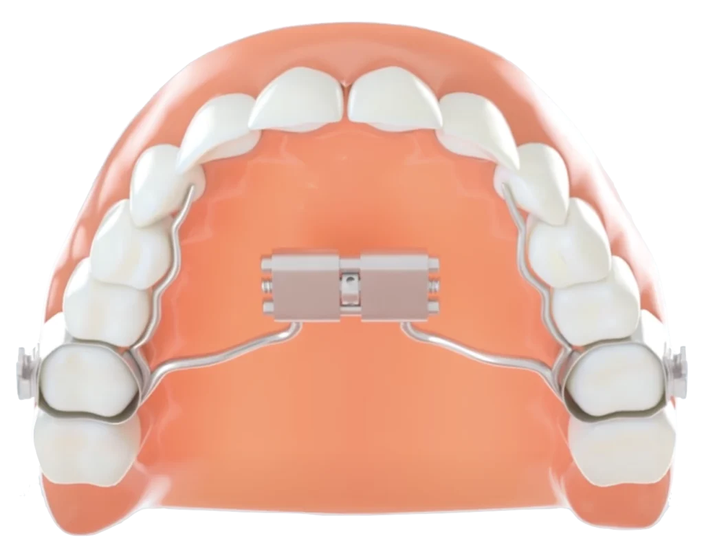 Appareil d'interception orthodontique pour enfant à La Fare-les-Oliviers, proche de Lançon