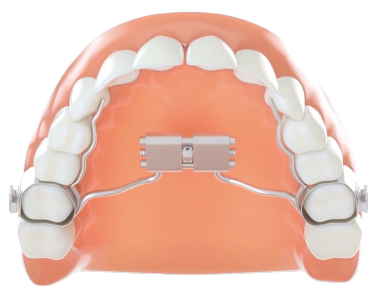 Appareil d'interception orthodontique pour enfant à La Fare-les-Oliviers, proche de Lançon